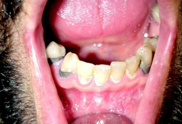 Meth Mouth