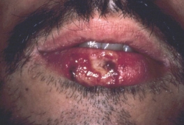 Oral Herpes