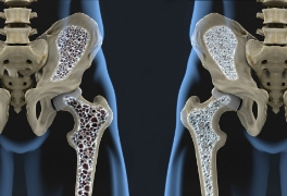 Osteoporosis