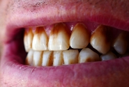 Tobacco Stained Teeth